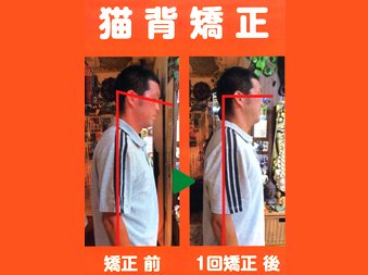 猫背矯正